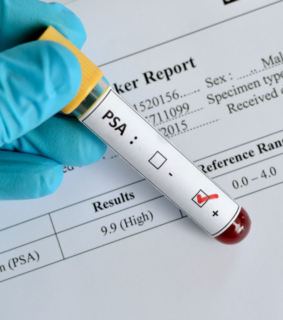 Gloved hand holding a PSA blood test vial over a medical report showing high results. The tone suggests clinical analysis and concern.
